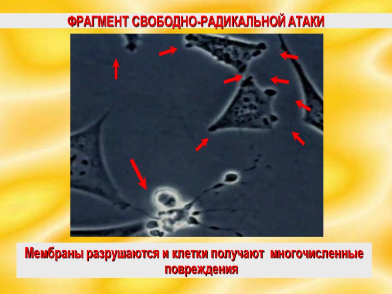 ФРАГМЕНТ СВОБОДНО-РАДИКАЛЬНОЙ АТАКИ Мембраны разрушаются и клетки получают  многочисленные повреждения